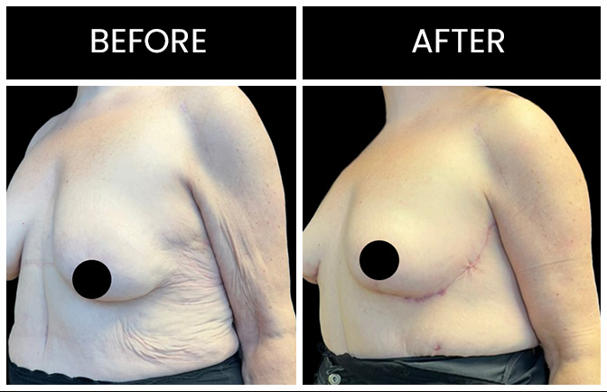 Arm Lift Results Atlanta